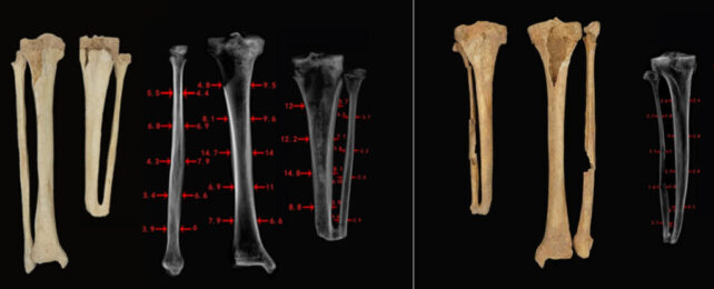 Panel of images showing two amputated and two intact lower leg bones, alongside X-ray images of the bones.