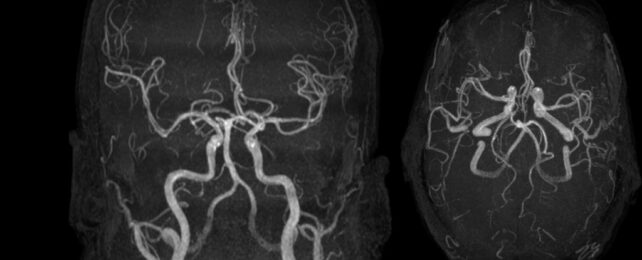 Images of major intercranial arteries