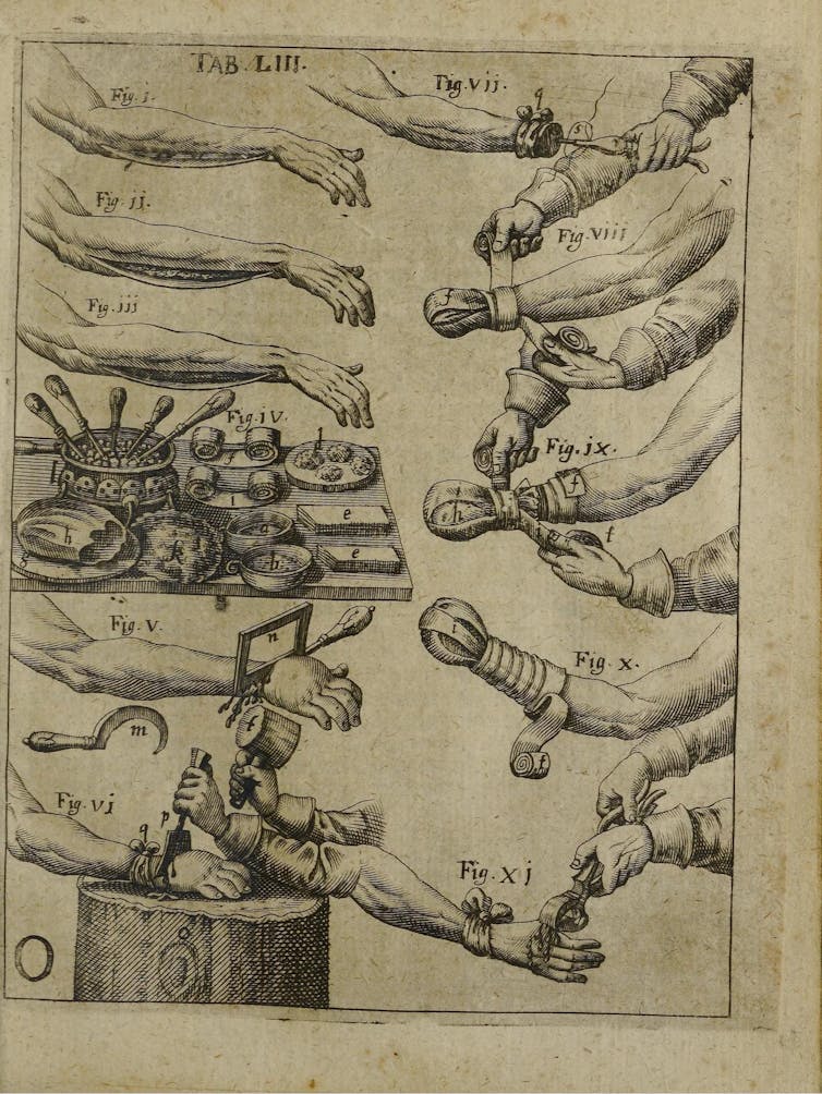 Parchment sketch illustrating multiple types of hand amputations, including with a mallet and chisel